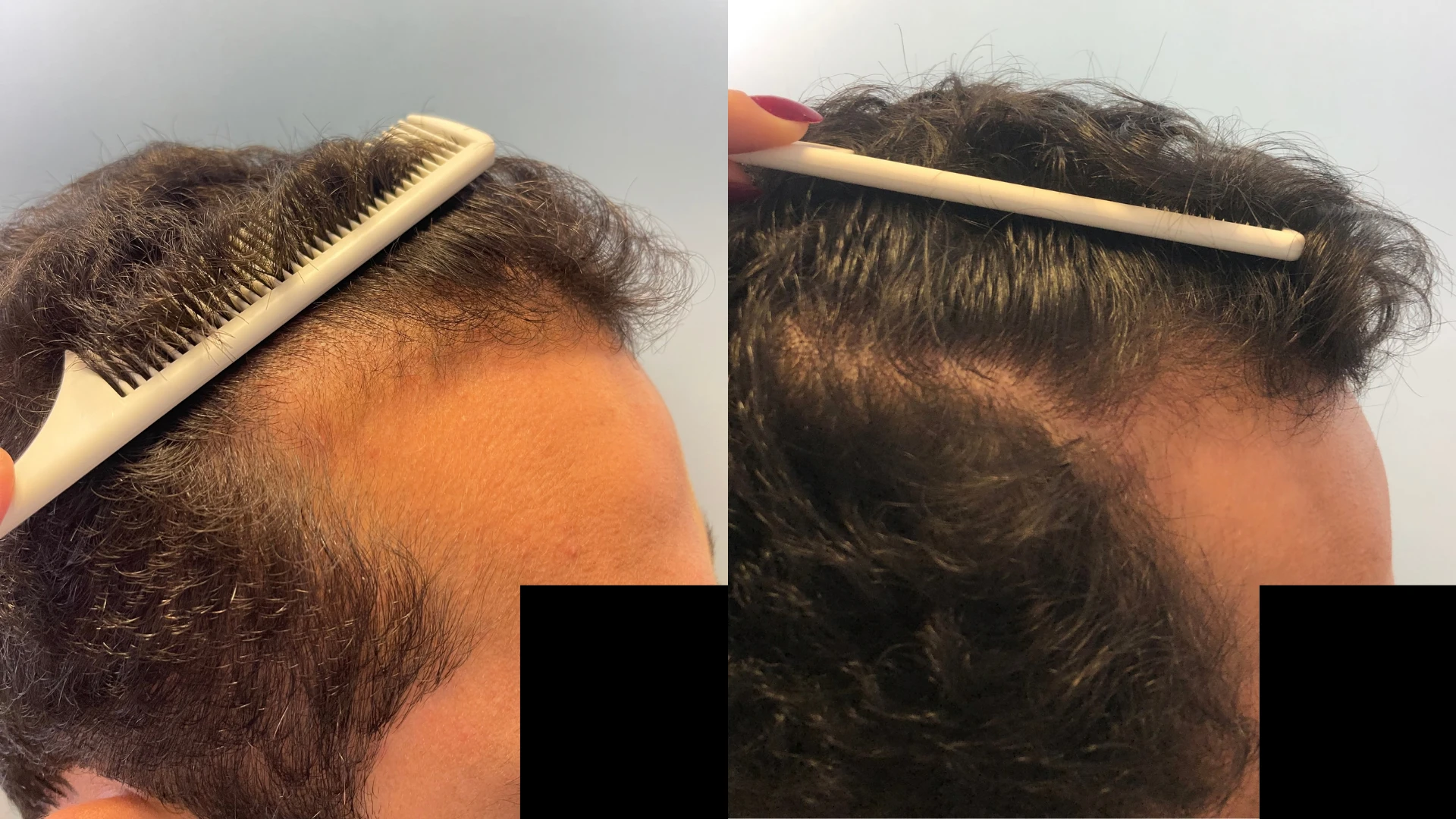 Antes e depois, caso 2