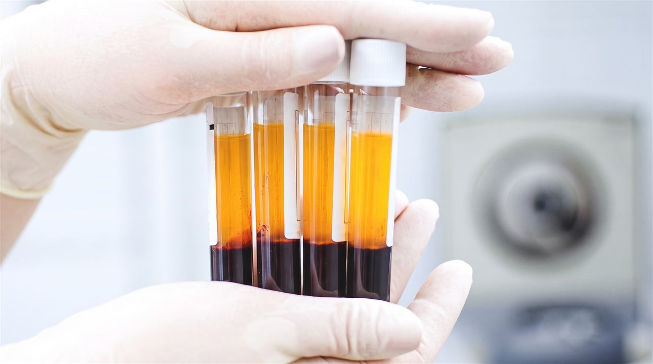 Tubos de PRP (Plasma Rico em Plaquetas) centrifugado