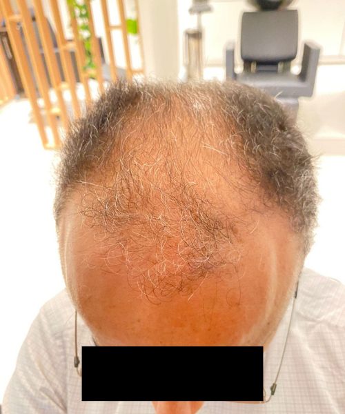 Antes, caso 2